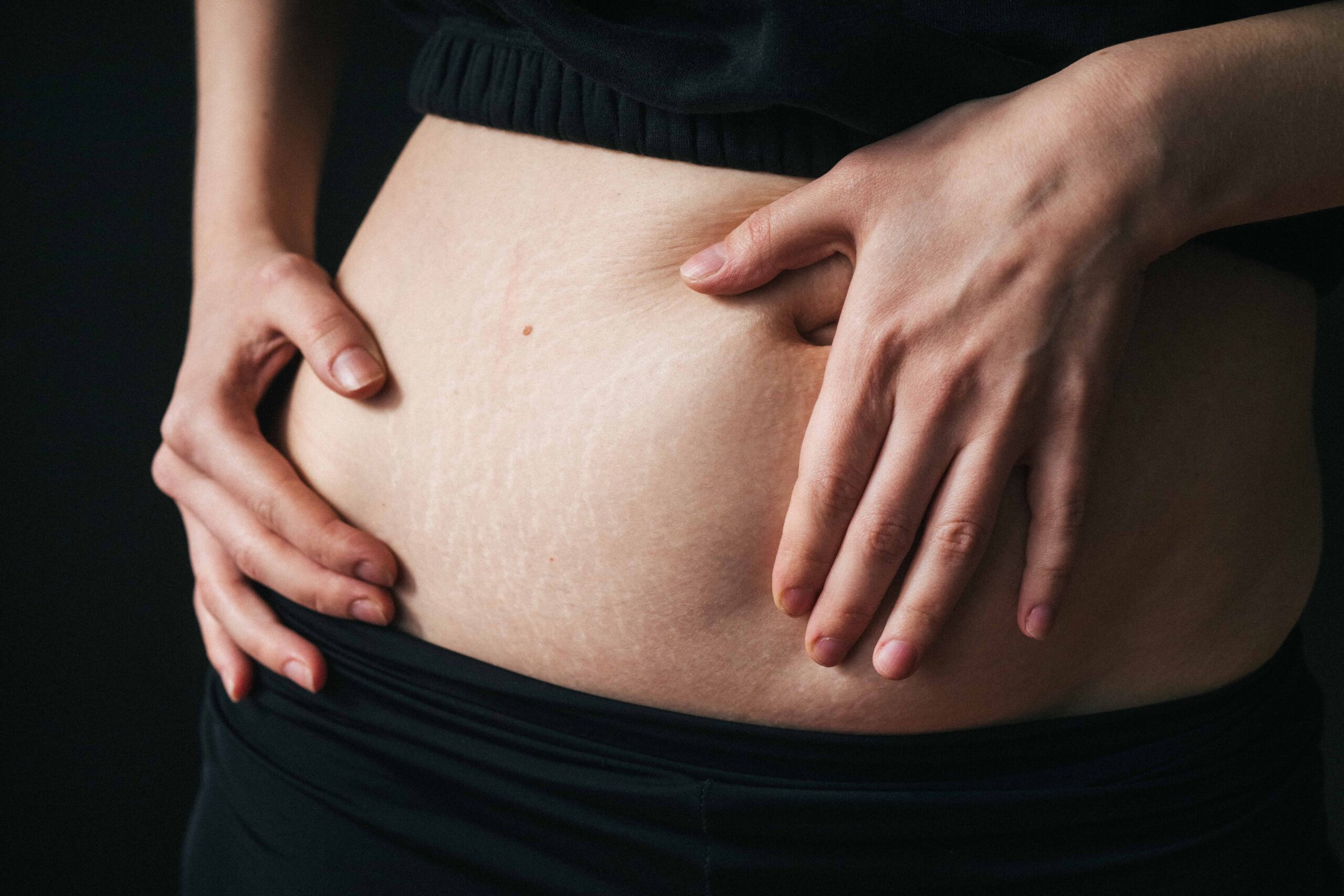 Stretch Marks: Understanding The Causes and Treatments